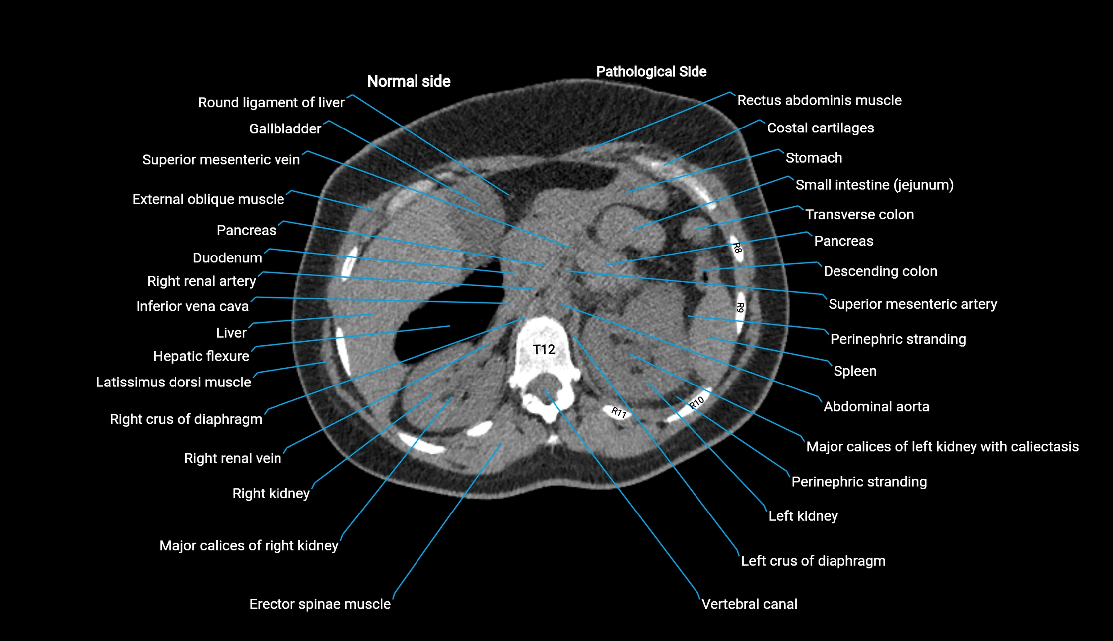 CT KUB axial cross sectional anatomy  radiology image -img-00201-00029.webp